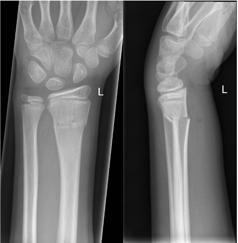 Fractures - Distal forearm or wrist