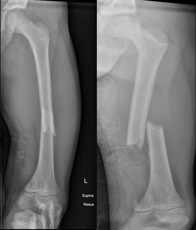 fractures-femur