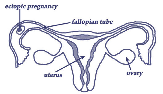 A diagram showing the uterus, ovaries, fallopian tube and an ectopic pregnancy located in fallopian tube