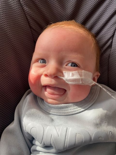 Baby Max with a nasogastric tube, smiling