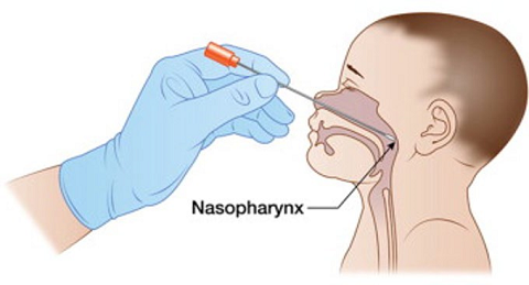 A diagram illustrating the correct technique for a nasopharyngeal swab