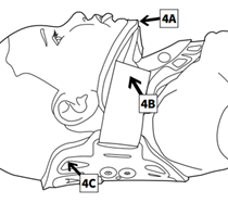 An illustration showing how to position an Aspen Pediatric Collar