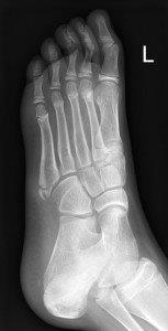 Avulsion fracture at base of fifth metatarsal