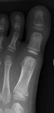 Single non-displaced metatarsal fracture