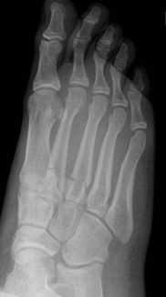 Multiple non-displaced metatarsal fractures