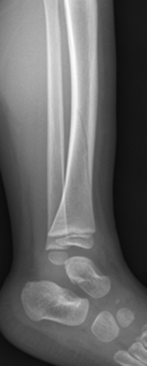 Toddler's fractures