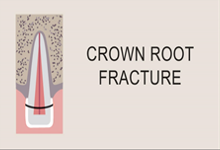 Crown root fracture
