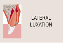 Lateral luxation