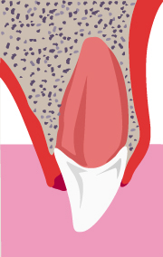 Illustration of displaced tooth into the gum along its long axis