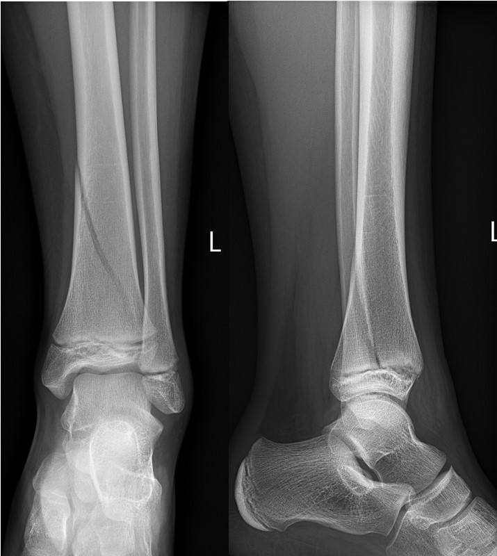 Minimally displaced Salter-Harris II fracture of the distal tibia
