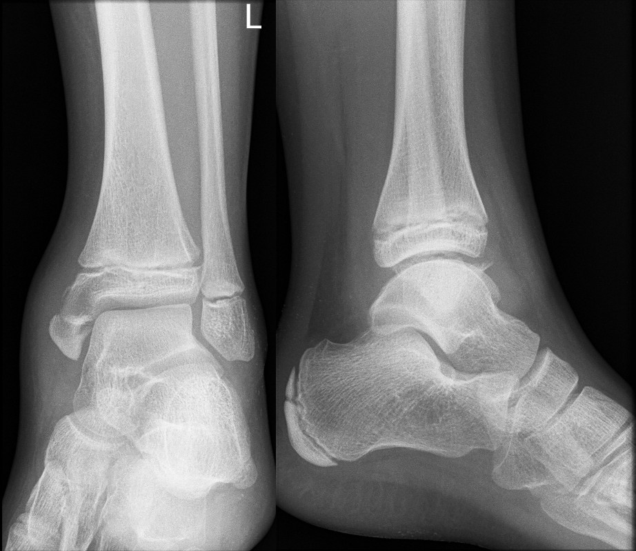 Salter-Harris III fracture of medial malleolus requiring internal fixation