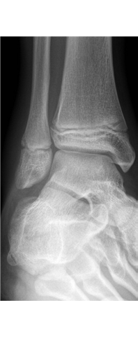 Minimally displaced Salter-Harris II fracture of distal fibula