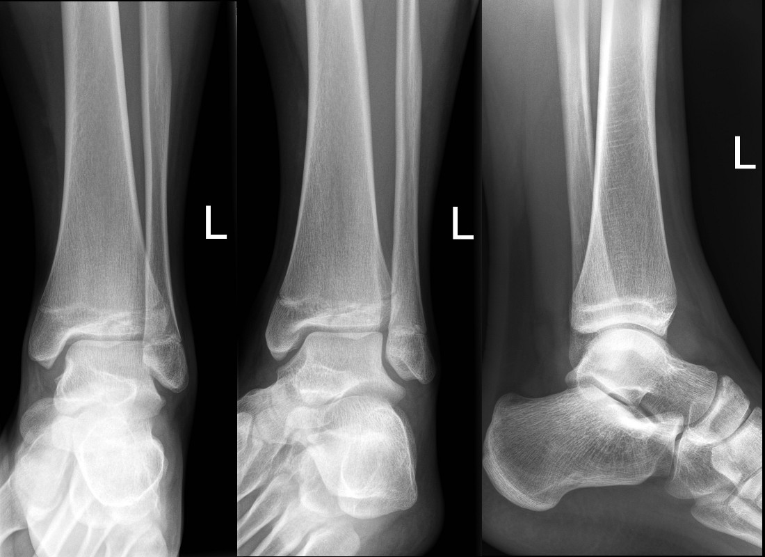 Minimally displaced Tilleaux fracture