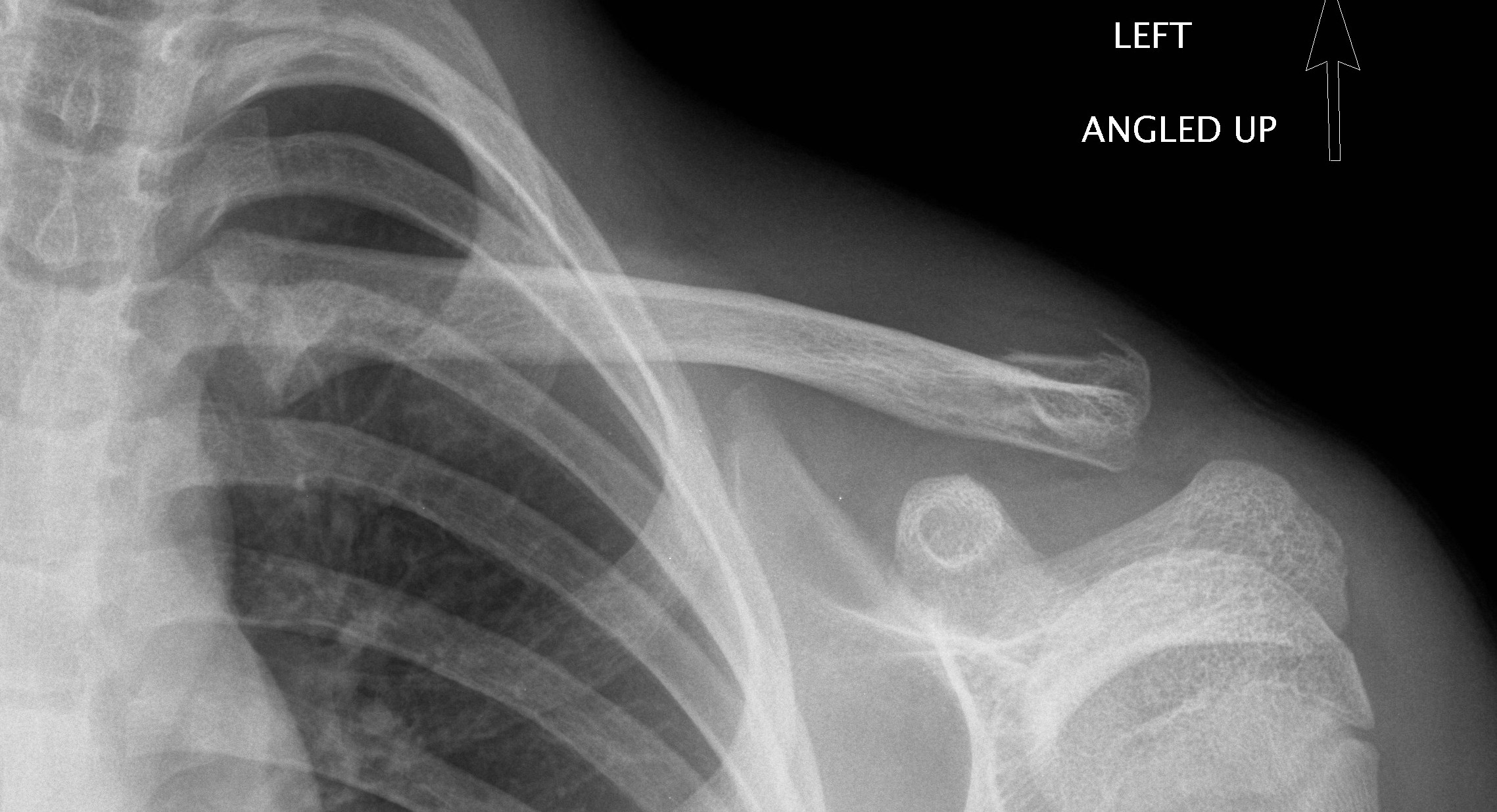 Lateral third clavicle fracture
