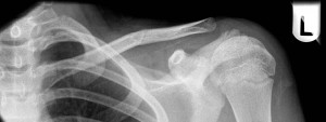 Minimally displaced middle third clavicle fracture