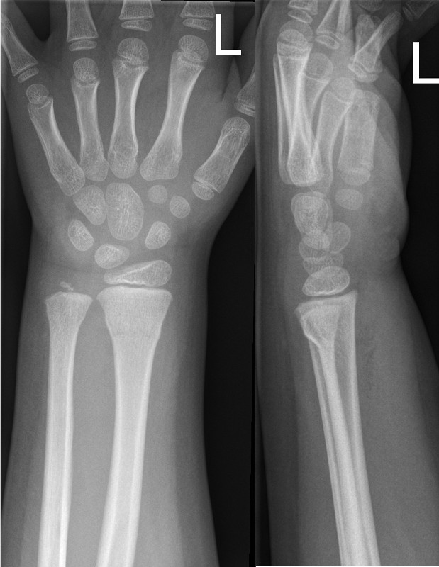 Buckle fracture of the distal radius and ulna with minimal dorsal angulation
