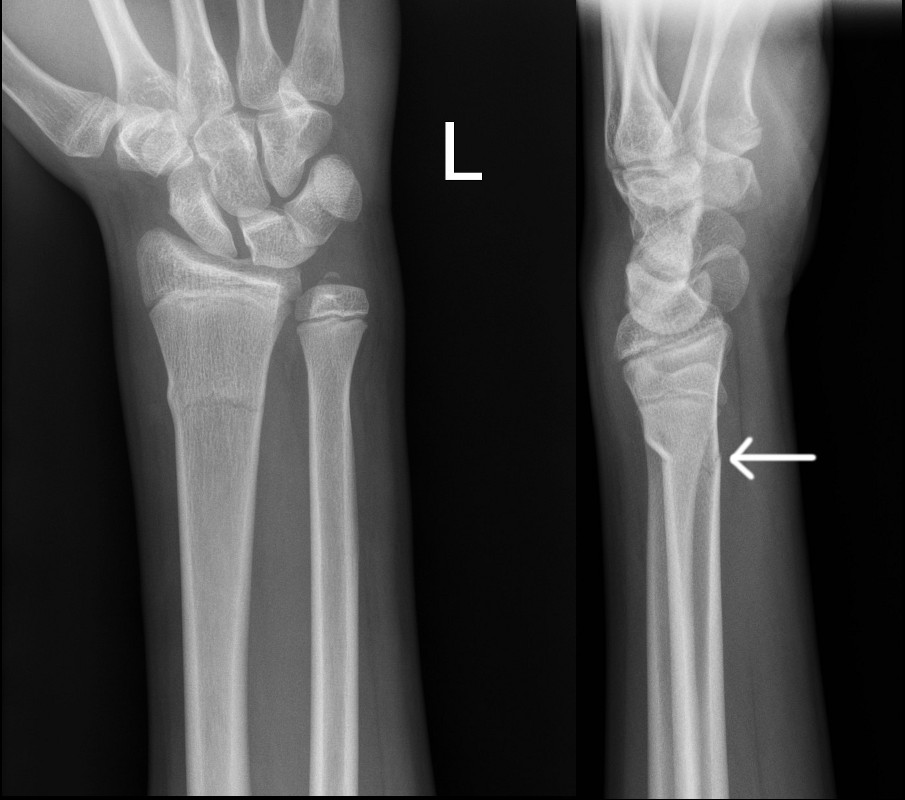 greenstick fracture x ray