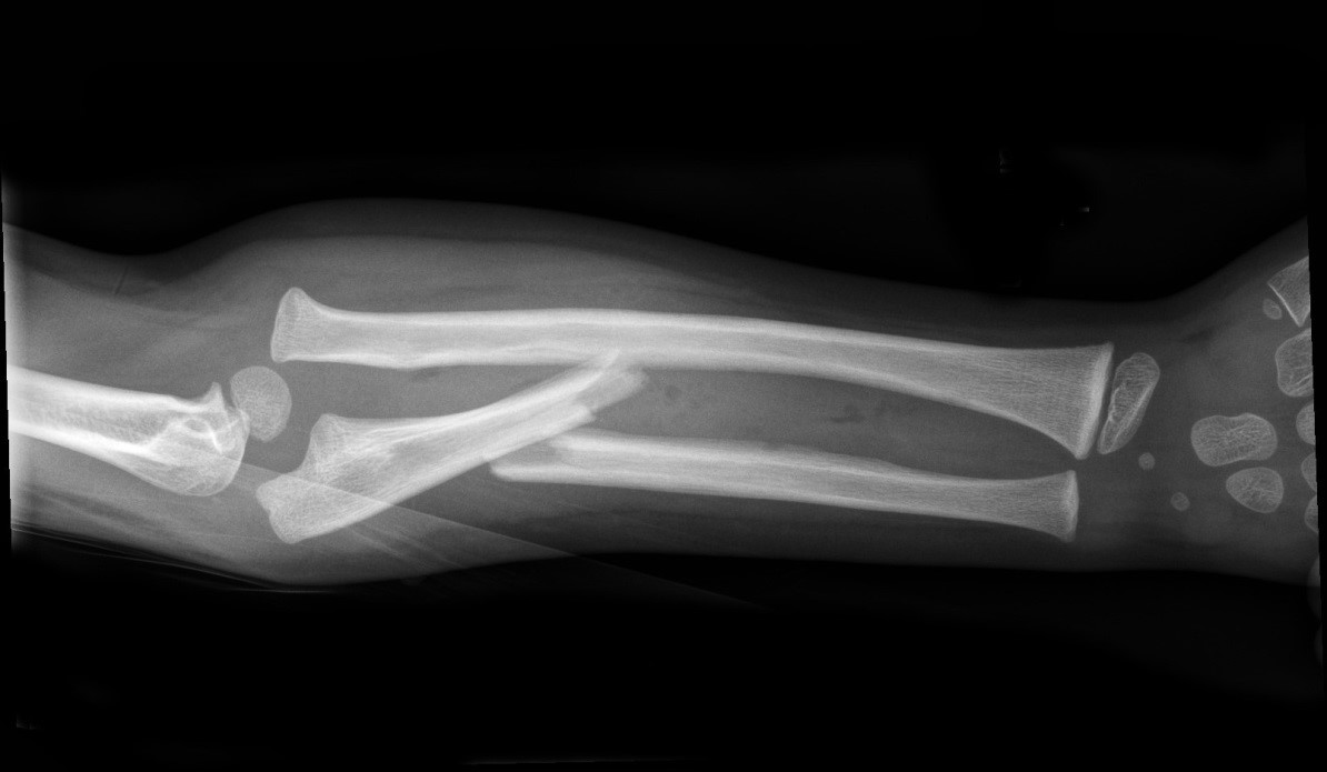 Monteggia fracture in a child on x-ray