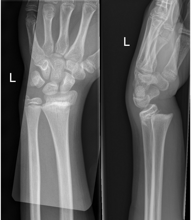 Fractures - Distal forearm or wrist