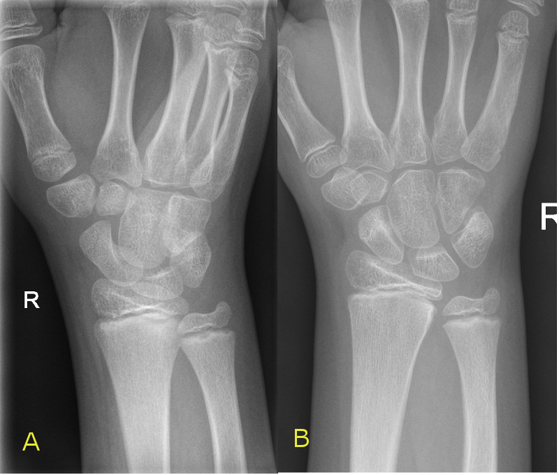 A is an undisplaced distal scaphoid. B is an image of sclerotic line in follow up X-Ray two weeks later