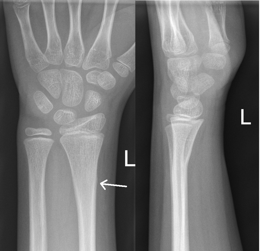 Subtle buckle fracture of distal radius on AP view (arrow) with obvious volar angulation on the lateral view