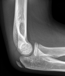 X-ray of elbow showing Anterior fat pad seen but NOT elevated, so NOT a joint effusion
