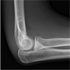 Elbow X-ray showing Anterior fat pad elevated off anterior surface of humerus = joint effusion