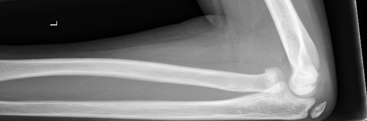 Minimally displaced radial neck fracture