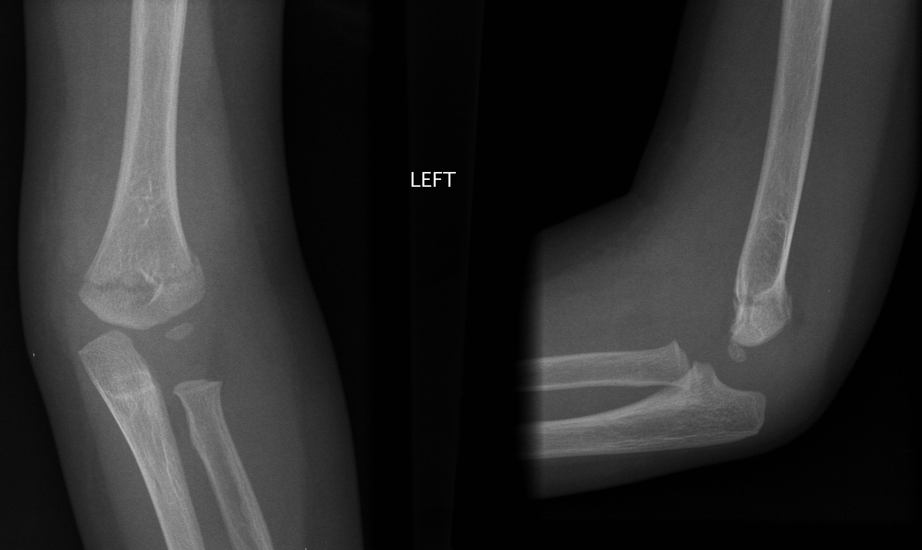 Supracondylar fracture with posterior angulation