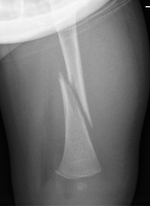 Spiral fracture in a 3 month old was a result of NAI. Note 'Bucket Handle' appearance of distal metaphysis