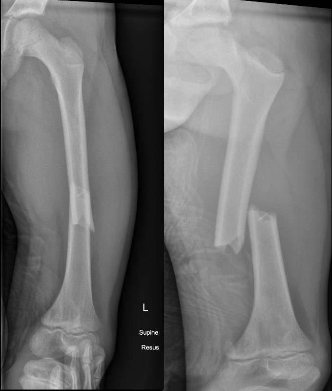 Transverse fracture with displacement and shortening secondary to a MVA