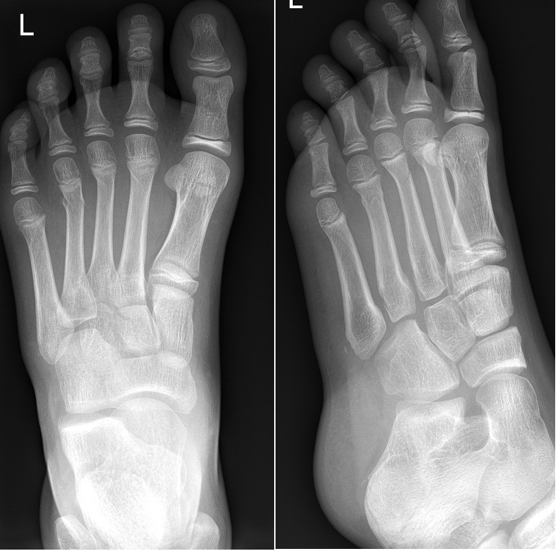 Fractures of distal 2nd-4th metatarsals
