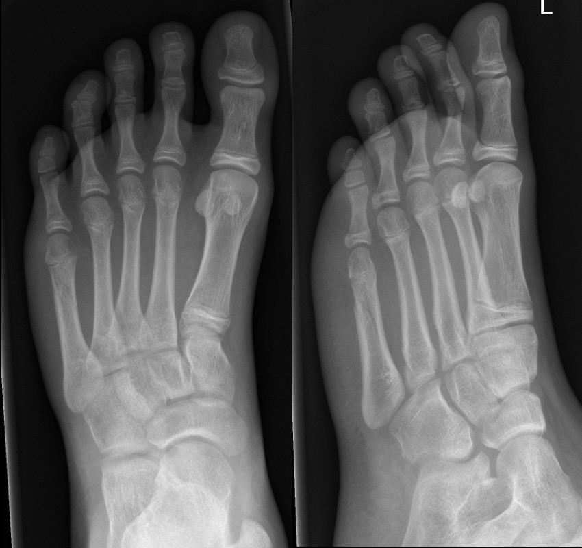 Minimally displaced oblique fracture of 5th metatarsal
