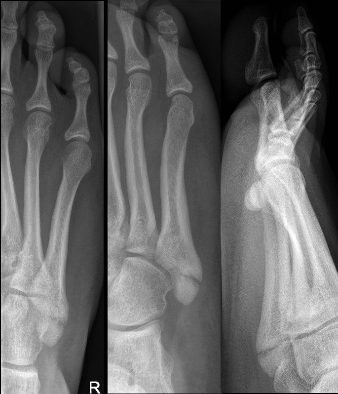 Fracture of base of 5th metatarsal following inversion injury