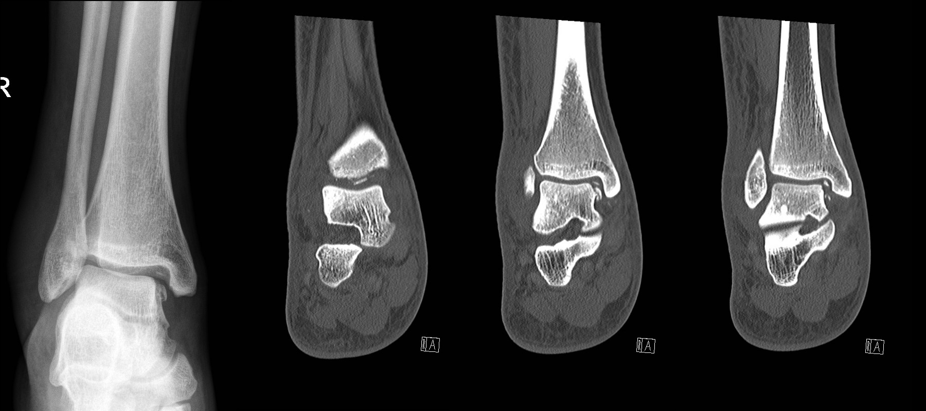 Talar dome fracture. X-ray (left) looks simple but CT shows multiple intra-articular bony fragments