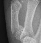 Displaced, angulated, or intra-articular fracture