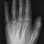 Undisplaced stable fractures of neck or shaft (2nd-5th metacarpal)