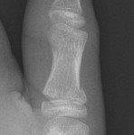 Undisplaced extra-articular fractures