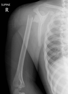 A completely displaced proximal humerus fracture