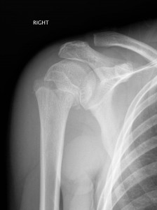 A Salter-Harris II fracture of proximal humerus
