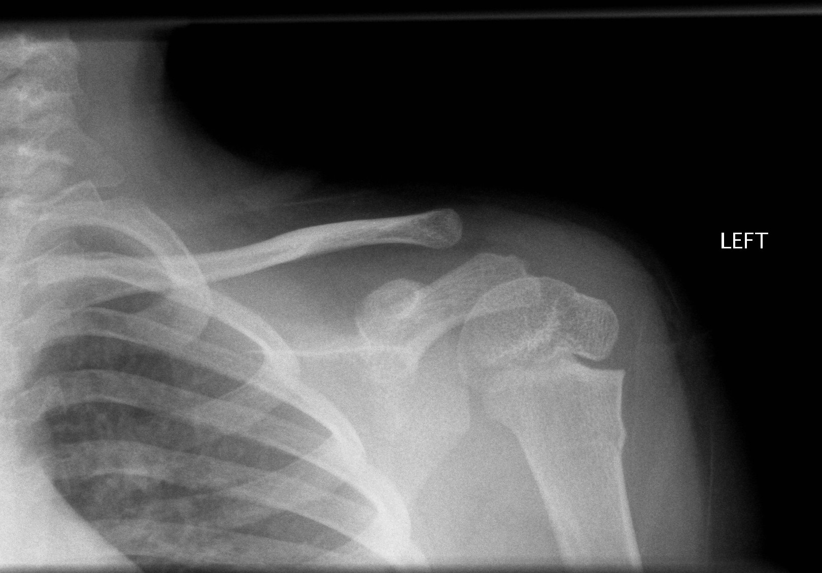 A buckle fracture of proximal humerus