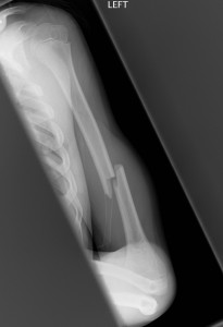 A complete fracture of shaft of humerus with mild displacement