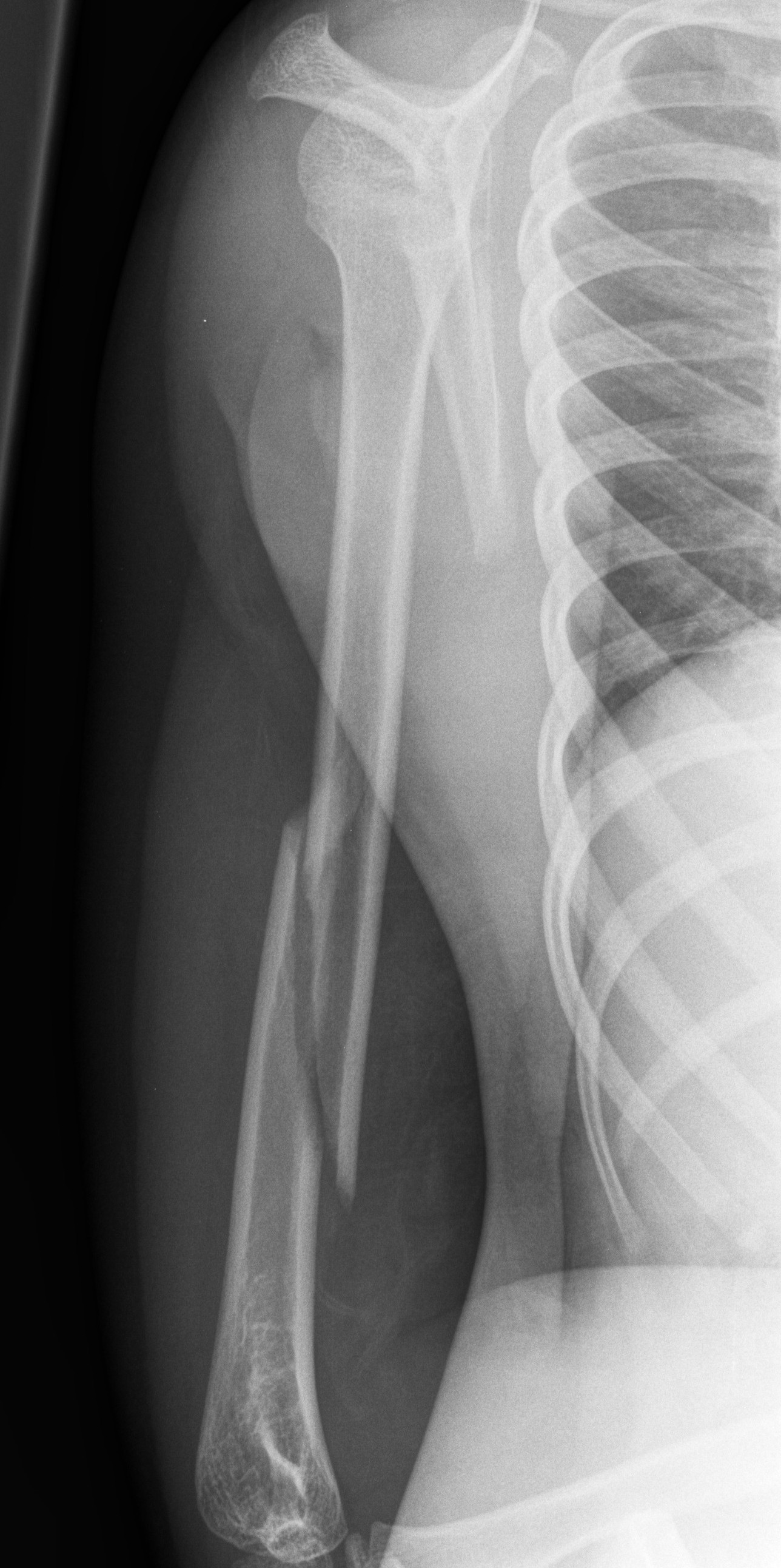 A spiral fracture of shaft of humerus
