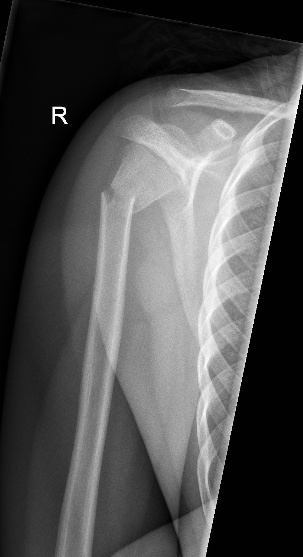 A proximal fracture with 40 degrees of angulation