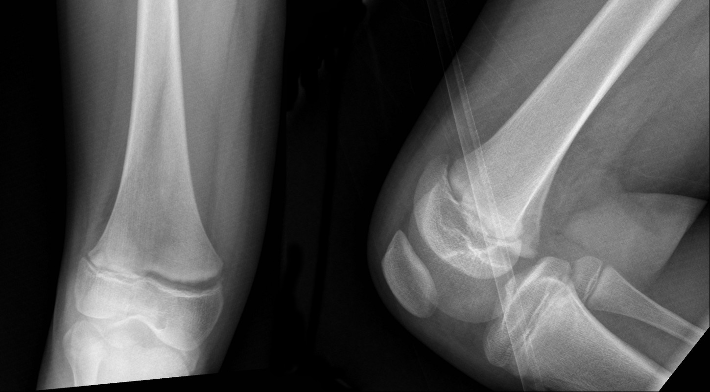 X-ray of distal femoral physeal fracture with widened physis with mild anterior displacement. Salter-Harris I Fracture