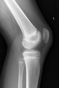 Patella sleve fracture. The patient clinically had difficulty extending the knee