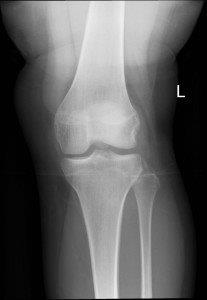 An x-ray avulsion fracture of lateral tibial condyle associated with ACL and medical meniscus injuries