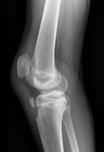 An x-ray of avulsion of tibial tuberosity with superior displacement. Note high riding patella