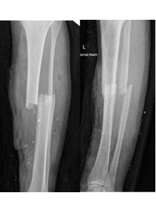 X-Ray of completely displaced tibial shaft and fibula fracture. A high risk of compartment syndrome