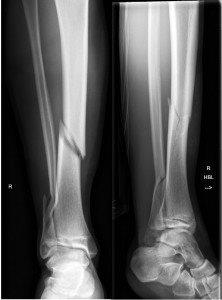 X-Ray of oblique comminuted fracture of tibia and fibula